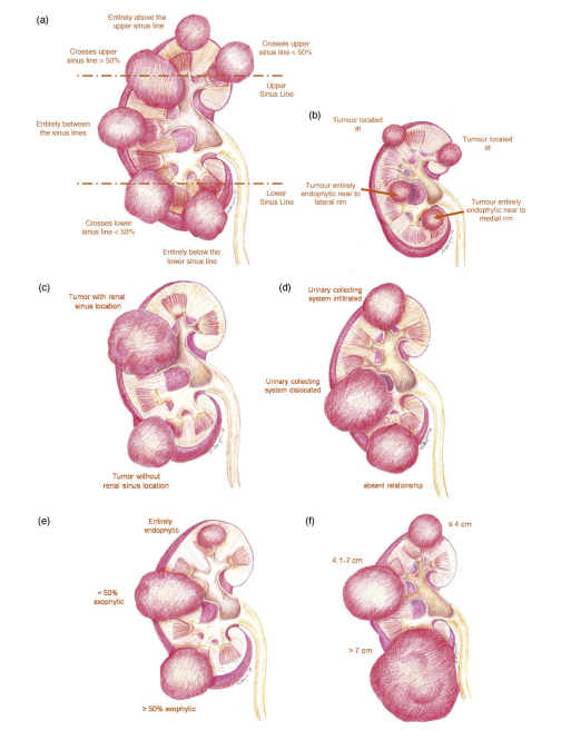 Figure 1: The patient-specific tumour characteristics that are taken into account to calculate the PADUA complexity score.  (V. Ficarra et al, Preoperative Aspects and Dimensions Used for an Anatomical (PADUA) Classification of Renal Tumours in Patients who are Candidates for Nephron-Sparing Surgery, European Urology, 2009.)